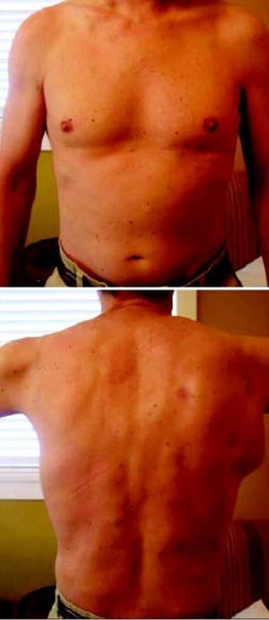 Panel B. Clinical photographs showing response to a targeted BRAF inhibitor, front and back